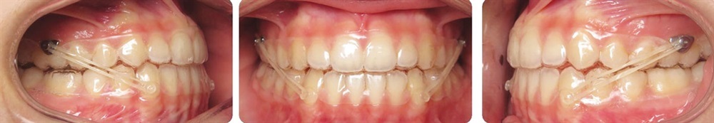 Off the Hook: Clear aligner attachments